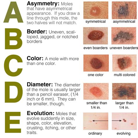 abcde skin cancer